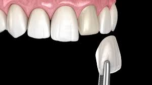 Composite Veneers
