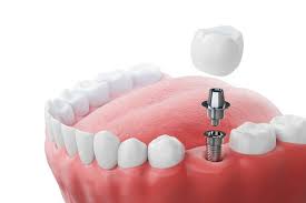 dental implants in Agra 