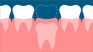 Fluoride Applications