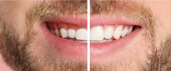 Teeth Re-contouring